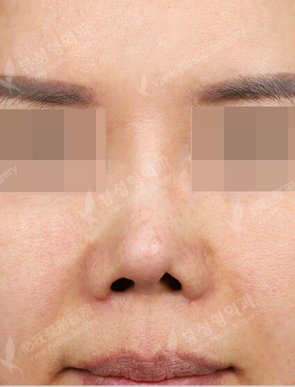Revisional Rhinoplasty (Donor Rib Cartilage)(3 Months) — Before