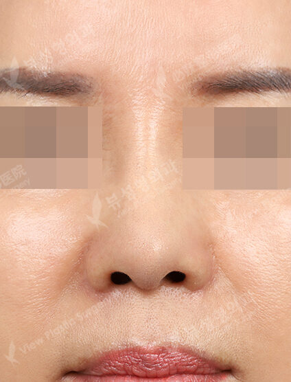 Revisional Rhinoplasty (Donor Rib Cartilage)(3 Months) — After