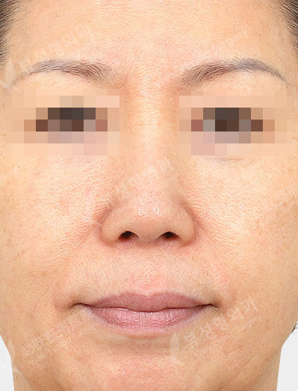 Revisional Rhinoplasty (3 Months) — Before