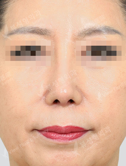 Revisional Rhinoplasty (3 Months) — After