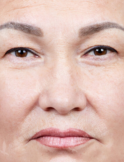 Rhinoplasty (3 Months) — Before