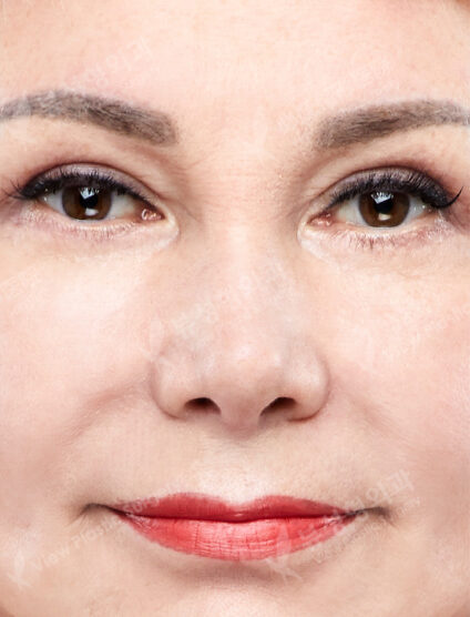 Rhinoplasty (3 Months) — After