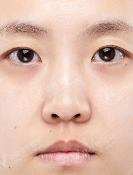 Low Nose (3 Months) — Before