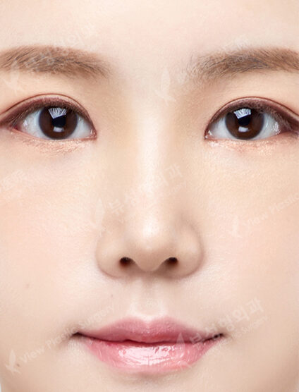 Low Nose (3 Months) — After