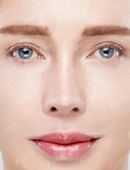 Hump NoseRevisional Surgery (6 Months)+ Nose Tip — After