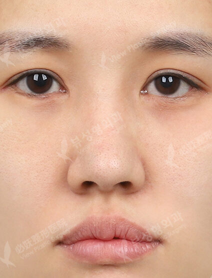 Revisional Rhinoplasty (3 Months) — Before