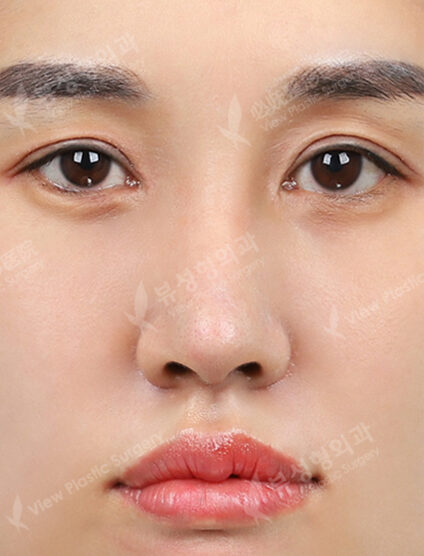 Revisional Rhinoplasty (3 Months) — After