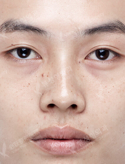 Low Nose (3 Months) — Before