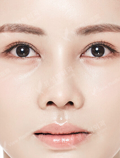 Low Nose (3 Months) — After