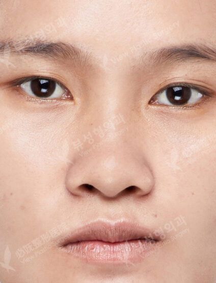 Low Nose (3 Months) — Before