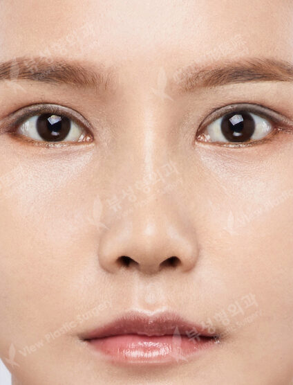 Low Nose (3 Months) — After