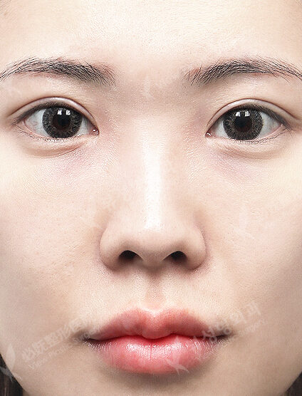 Revisional Rhinoplasty (12 Months) — Before