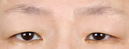 Upper Blepharoplasty (3 Months) — Before