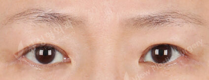 Upper Blepharoplasty (3 Months) — After