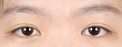 Incisional Ptosis Correction (Revisional Surgery)(4 Months) — Before