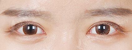 Incisional Ptosis Correction (Revisional Surgery)(4 Months) — After