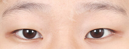 Combination Ptosis Correction Surgery+Epicanthoplasty (3 Months) — Before