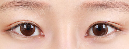 Combination Ptosis Correction Surgery+Epicanthoplasty (3 Months) — After