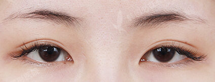Combination Ptosis Correction Surgery+Epicanthoplasty (3 Months) — Before