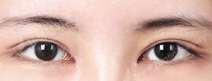 Combination Ptosis Correction Surgery+Epicanthoplasty (3 Months) — After