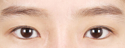 Revisional Eye Surgery+Epicanthoplasty (3 Months) — Before