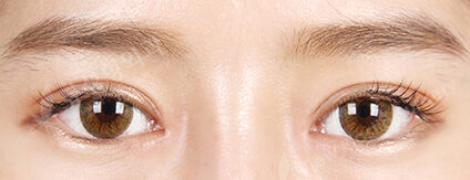 Revisional Eye Surgery+Epicanthoplasty (3 Months) — After