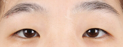 Incisional Ptosis Correction+Epicanthoplasty (3 Months) — Before