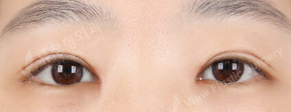Incisional Ptosis Correction+Epicanthoplasty (3 Months) — After