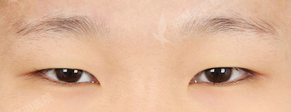 Combination Ptosis Correction Surgery (3 Months) — Before
