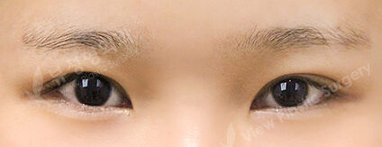 Combination Ptosis Correction Surgery (3 Months) — After