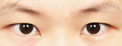 Incisional(7 Months) — Before