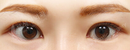 Incisional(7 Months) — After