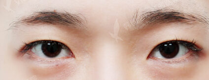 Combination Ptosis Correction Surgery+Epicanthoplasty+Lateral Canthoplasty+Lower Canthoplasty (3 Months) — Before