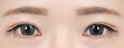 Combination Ptosis Correction Surgery+Epicanthoplasty+Lateral Canthoplasty+Lower Canthoplasty (3 Months) — After