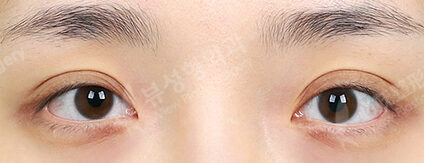Transconjuntival fat removal+Filler (Under-eye)(7 Months) — Before