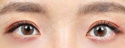 Transconjuntival fat removal+Filler (Under-eye)(7 Months) — After