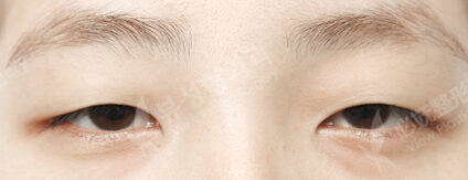 Burial+Ptosis (3 Months) — Before