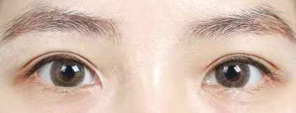 Burial+Ptosis (3 Months) — After