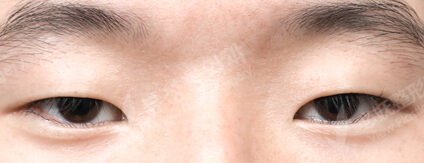 Incisional Burial Method+Epicanthoplasty+Lower Canthoplasty (3 Months) — Before
