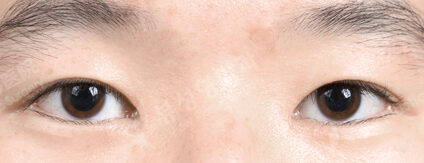 Incisional Burial Method+Epicanthoplasty+Lower Canthoplasty (3 Months) — After