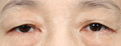 Lower Blepharoplasty+Brow Lift (3 Months) — Before