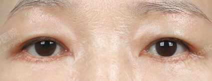 Lower Blepharoplasty+Brow Lift (3 Months) — After