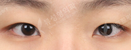 Incisional Burial Method+Epicanthoplasty+Nose Tip (3 Months) — Before