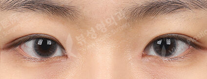 Incisional Burial Method+Epicanthoplasty+Nose Tip (3 Months) — After