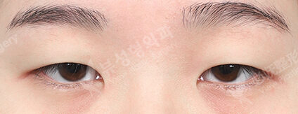Incisional Double Eyelid Surgery+Ptosis Correction+Epicanthoplasty (3 Months) — Before