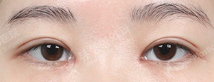 Incisional Double Eyelid Surgery+Ptosis Correction+Epicanthoplasty (3 Months) — After
