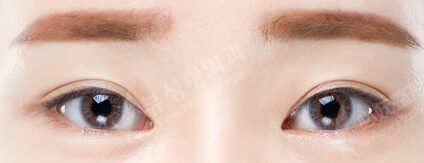 Lateral Canthoplasty + Lower Canthoplasty (10 Months) — Before