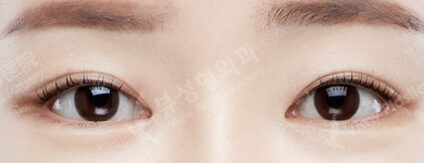 Lateral Canthoplasty + Lower Canthoplasty (10 Months) — After