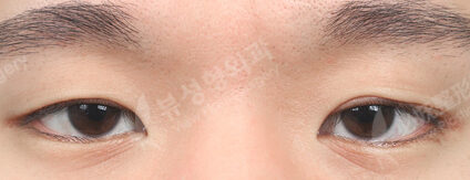 Double Eyelid Burial method (3 Months) — Before