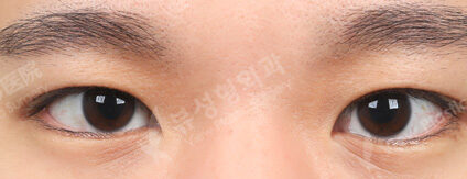Double Eyelid Burial method (3 Months) — After